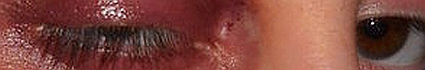 [Image: bruise.jpg]